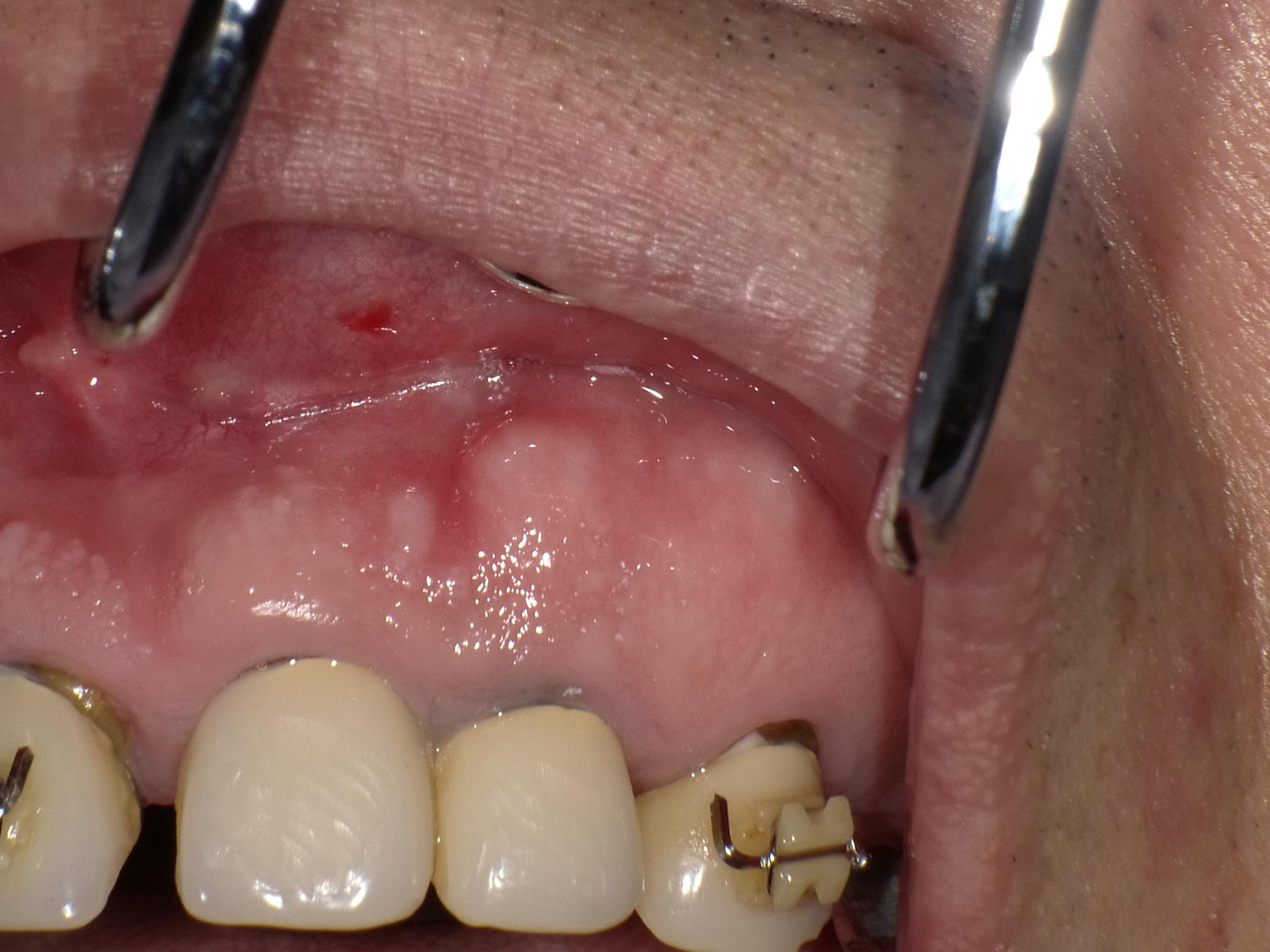 【精密根管治療】歯茎が腫れて膿みが出ている。矯正医からご紹介の患者様。