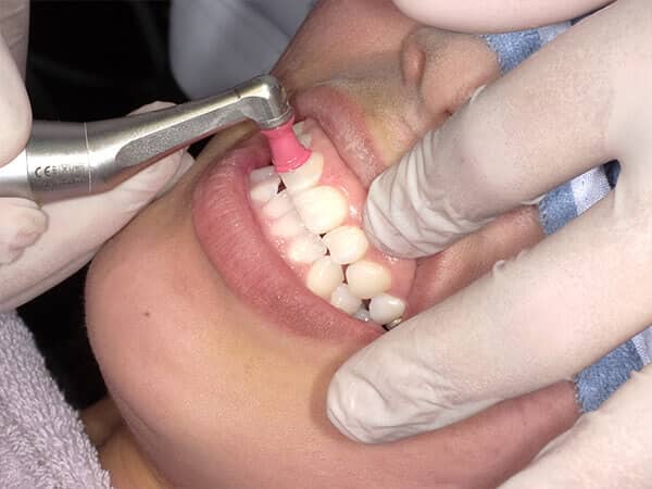 STEP5：歯の表面を研磨