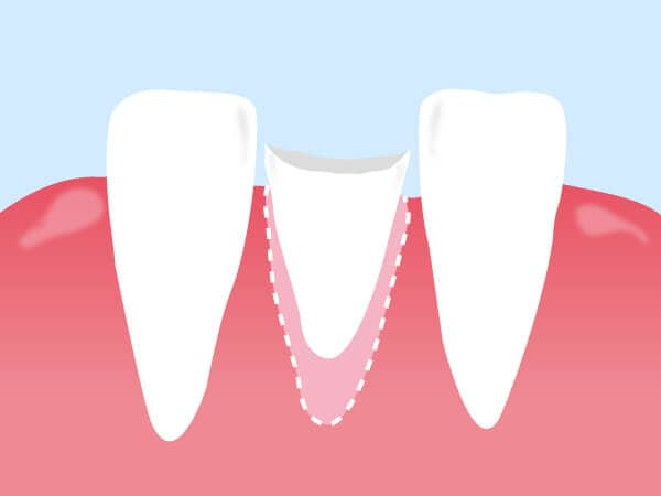 LOT治療で歯を引き上げることで、歯を保存できます