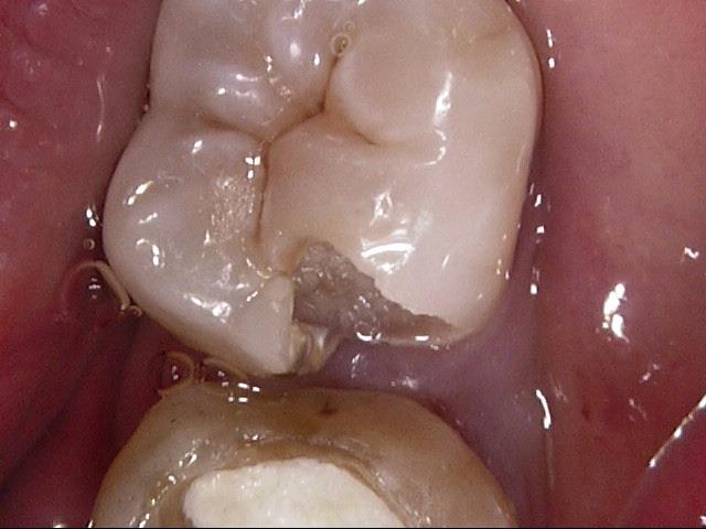 【MTA直接覆髄法】重度のむし歯でも歯の神経が残せる場合があります。