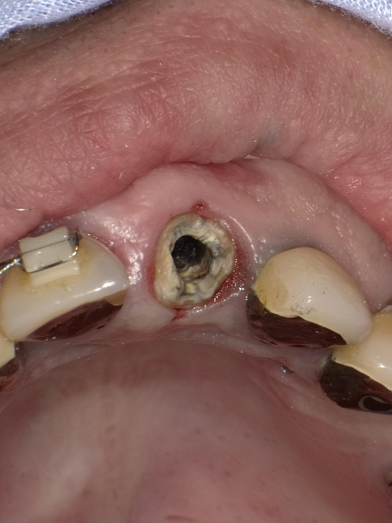 が 痛い 歯茎 腫れ て 歯茎の腫れは痛みがあってもなくても危険サインの信号