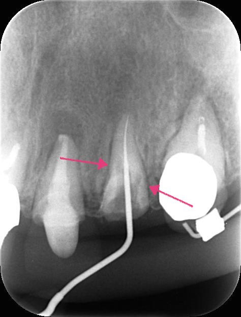 【精密根管治療】パーフォレーション（穿孔）している歯の治療