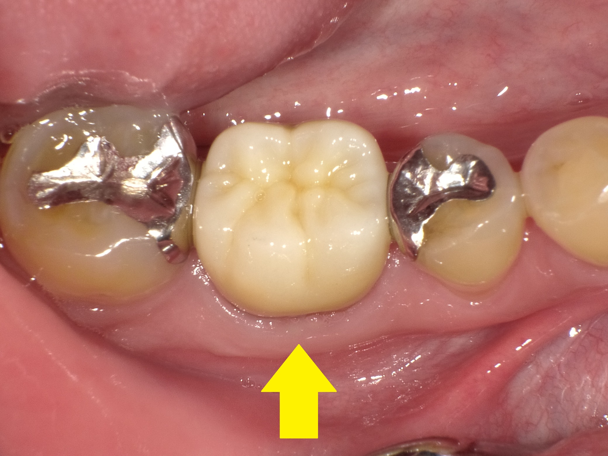 【精密根管治療経過報告】続・歯ぐきのニキビのような腫れを治したい。
