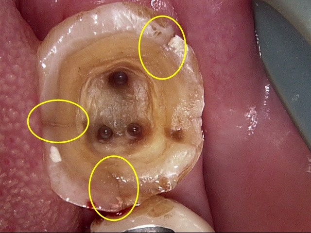 【セカンドオピニオン】他院にて左下奥歯の歯根（根管）治療中。先生の意見が聞きたい！！
