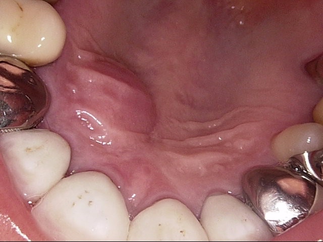 【逆根管充填（MTAセメント）・巨大歯根嚢胞】他院では、歯根端切除術は難しく抜歯をすすめられた！