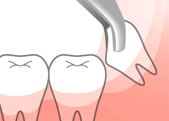 残りの歯の除去